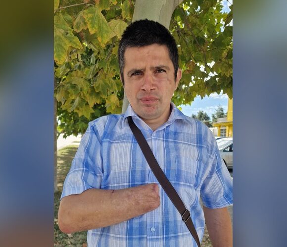 Proteză pentru mâna dreaptă Proteză pentru mâna dreaptă